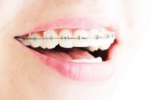 ortodoncia-brackets