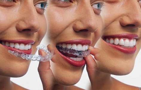 Cómo funciona el Invisalign.