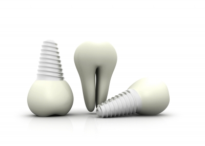 tipos de implantes dentales