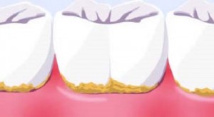 placa dental