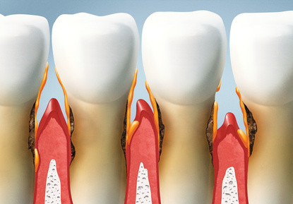 treat your teeth, periodontal