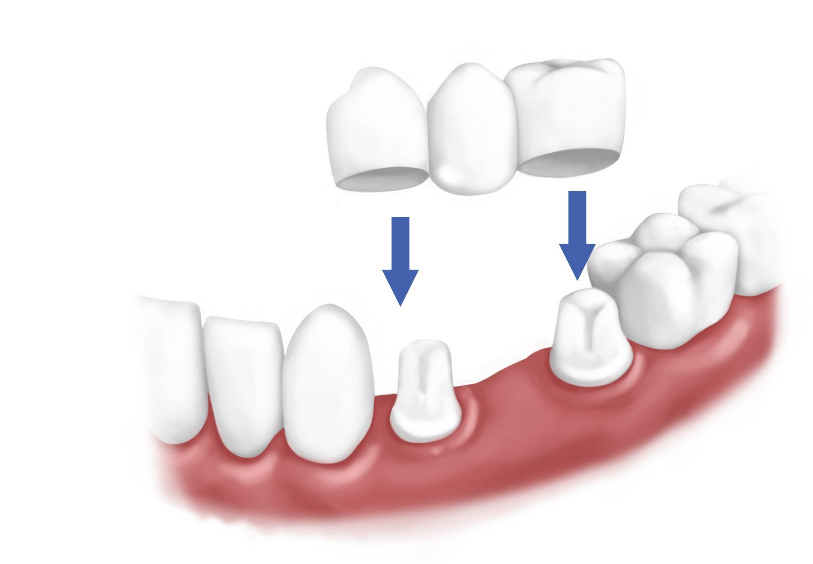 puente-dental