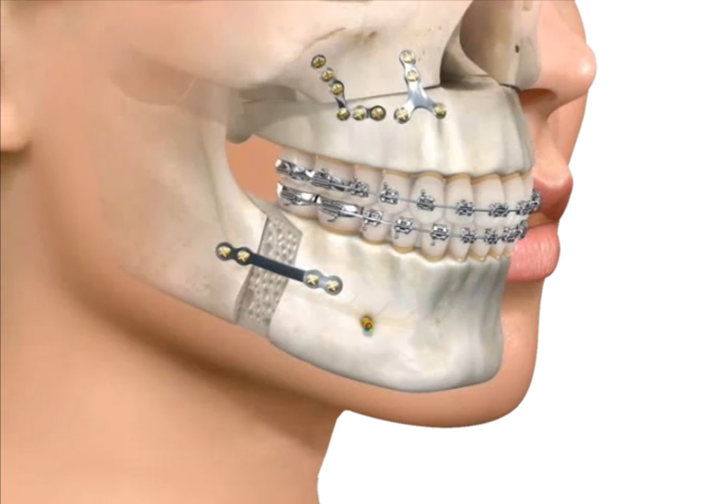 CIRUJIAMAXILOFACIAL miradent