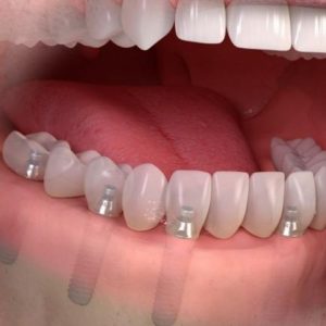 implantes-fijos