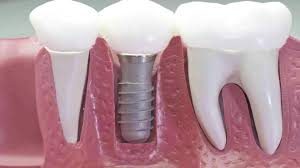 tipos de mplantes dentales
