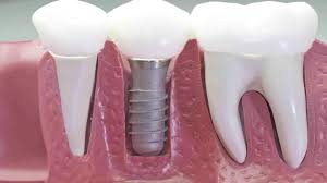 implantes dentales corona