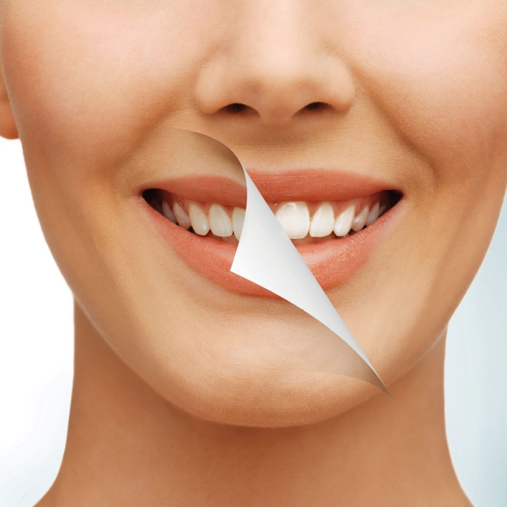 Blanqueamiento dental, efectos sobre tus dientes.